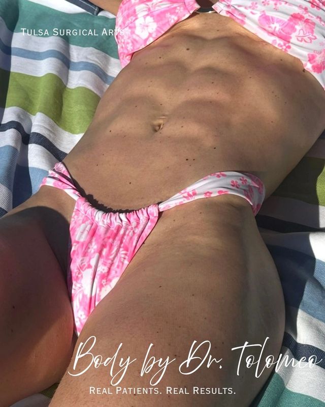 Real patient of Tulsa Surgical Arts — hi-def liposuction by Dr. Tolomeo