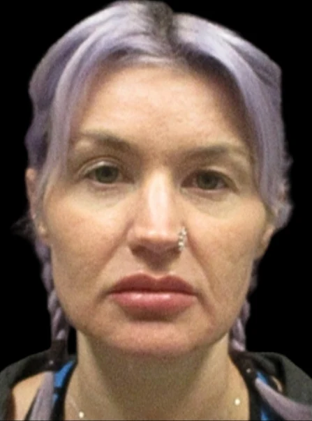 Before: Upper Blepharoplasty — front · by Carisa Champion, DO