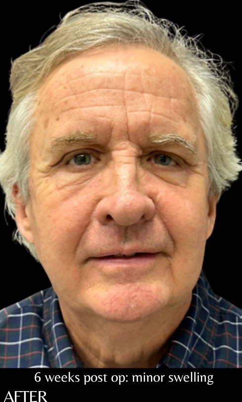 After: Blepharoplasty — front · by Angelo Cuzalina, MD, DDS