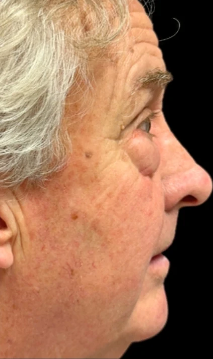Before: Blepharoplasty — profile · by Angelo Cuzalina, MD, DDS