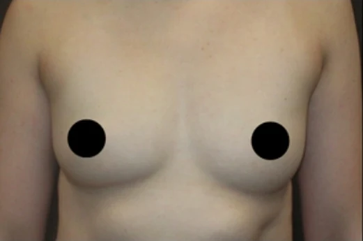 Before: Breast Augmentation · by Angelo Cuzalina, MD, DDS