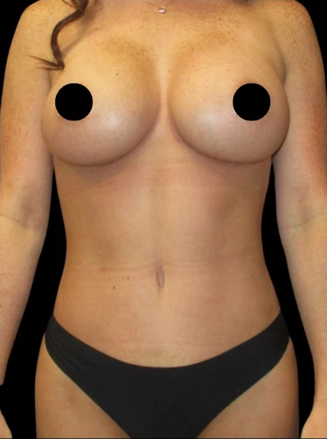 After: Breast Augmentation, Full Tummy Tuck, Lipo to Hips, BBL · by Angelo Cuzalina, MD, DDS