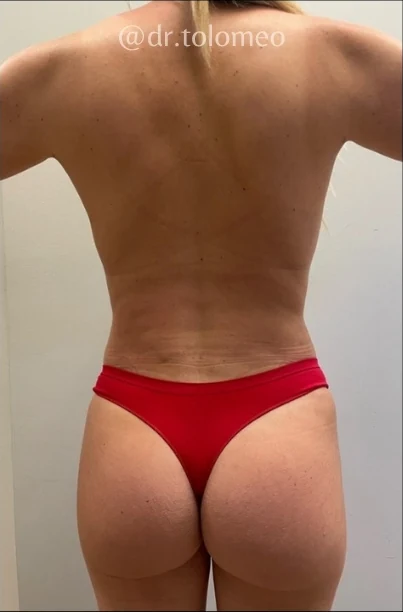 After: Breast Aug & Hidef Lipo — back · by Pasquale Tolomeo, MD
