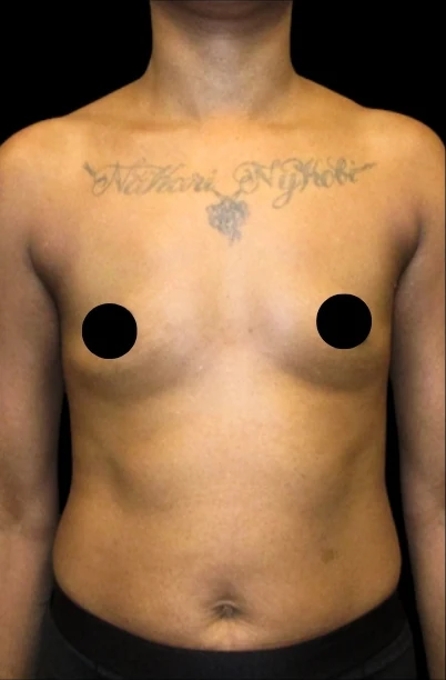 Before: Breast Augmentation — front · by Angelo Cuzalina, MD, DDS