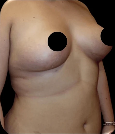 After: Breast Lift — front-torso · by Angelo Cuzalina, MD, DDS