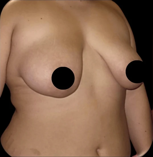 Before: Breast Lift — front-torso · by Angelo Cuzalina, MD, DDS