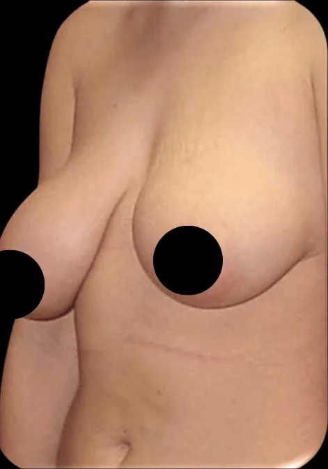 Before: Breast Lift — oblique · by Angelo Cuzalina, MD, DDS