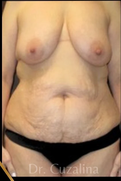 Before: Breast Lift w/out Implants, Full Tummy Tuck — front · by Angelo Cuzalina, MD, DDS