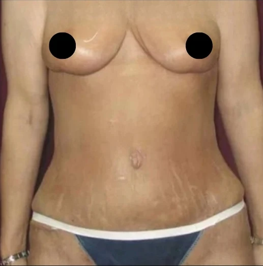 After: Breast Reduction & Lift, Tummy Tuck, Lipo360 · by Angelo Cuzalina, MD, DDS