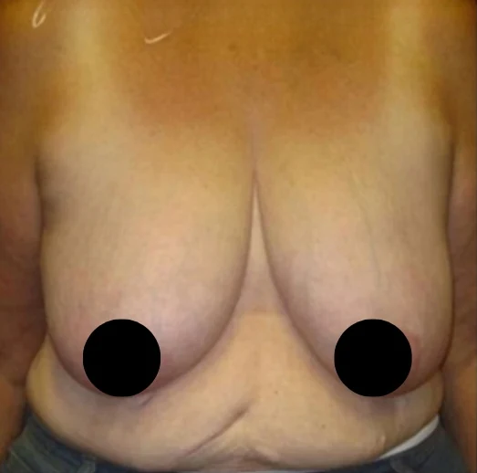 Before: Breast Reduction & Lift · by Angelo Cuzalina, MD, DDS