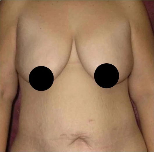 Before: Breast Reduction & Aug/Lift, Tummy Tuck, Lipo360 · by Angelo Cuzalina, MD, DDS