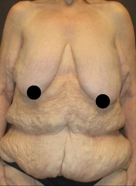Before: Full Tummy Tuck, Liposuction, Breast Reduction & Lift · by Angelo Cuzalina, MD, DDS