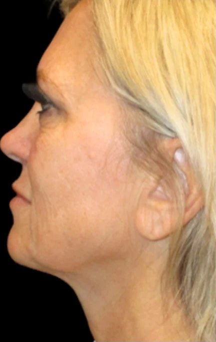 Before: Full Lower Face & Neck Lift, Endoscopic Forehead & Brow Lift, CO2 Laser Resurfacing — profile · by Angelo Cuzalina, MD, DDS