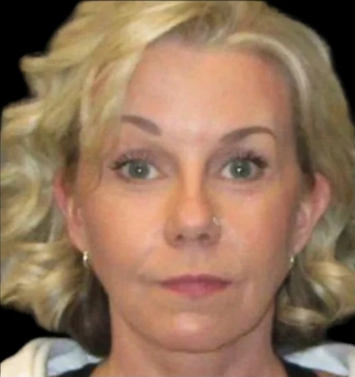 After: Lower Face & Neck Lift, Fat Grafting, Laser Skin Resurfacing, Upper Blephs · by Angelo Cuzalina, MD, DDS