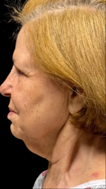 Before: Lower Face & Neck Lift · by Angelo Cuzalina, MD, DDS