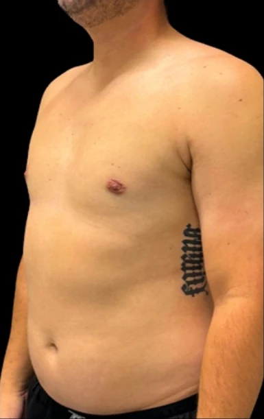 After: Lipo to Chest, Excision of Tissue with Vaser — oblique · by Angelo Cuzalina, MD, DDS