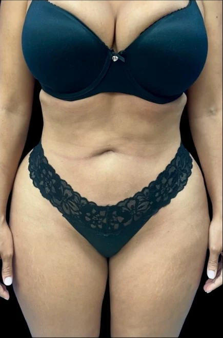 Before: Hidef Lipo & Thigh Lipo w/ Vaser Renuvion — front · by Pasquale Tolomeo, MD