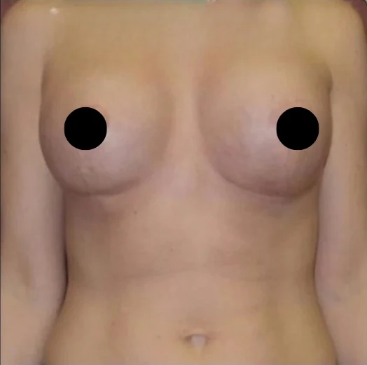 After: Breast Augmentation, Lift, & Revision · by Angelo Cuzalina, MD, DDS