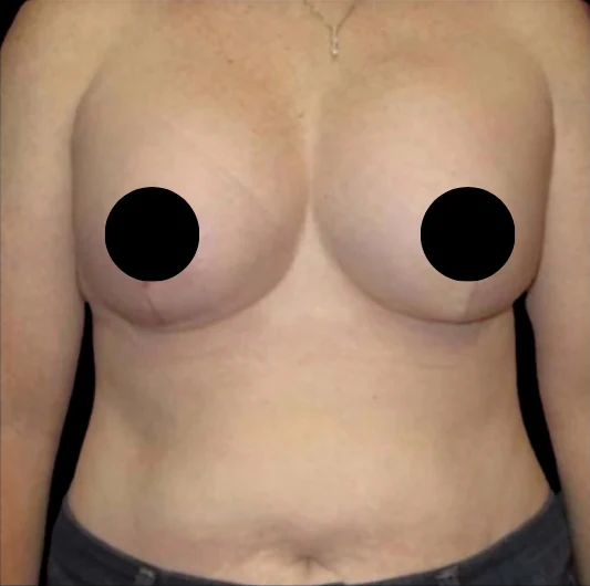 After: Breast Augmentation, Lift, & Revision · by Angelo Cuzalina, MD, DDS