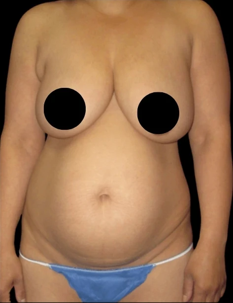 Before: Breast Aug/Lift, Tummy Tuck, Lipo360 · by Angelo Cuzalina, MD, DDS