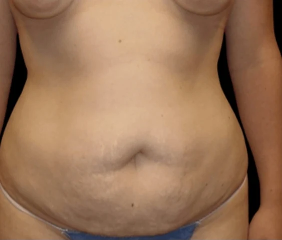 Before: Breast Aug/Lift, Tummy Tuck, & Lipo360 · by Angelo Cuzalina, MD, DDS
