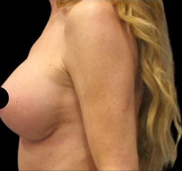 After: Breast Aug/Lift · by Angelo Cuzalina, MD, DDS
