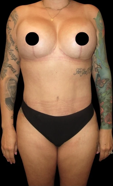 After: Breast Aug/Lift, Tummy Tuck, Lipo360, BBL and Arm Lipo · by Angelo Cuzalina, MD, DDS