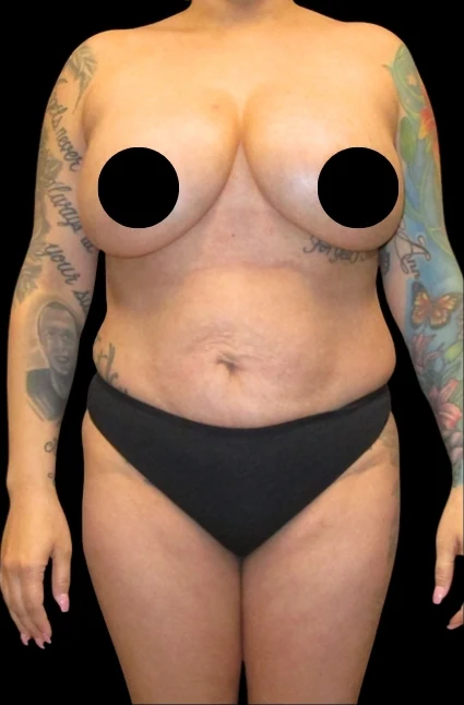 Before: Breast Aug/Lift, Tummy Tuck, Lipo360, BBL and Arm Lipo · by Angelo Cuzalina, MD, DDS