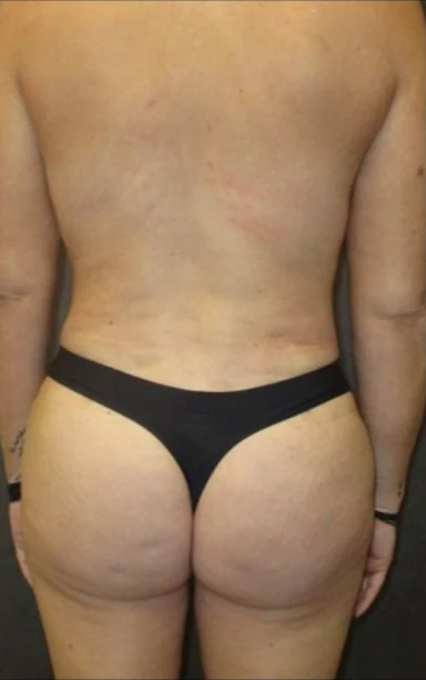 After: Tummy Tuck, Lipo to Abdomen, Breast Aug/Lift & BBL — back · by Angelo Cuzalina, MD, DDS