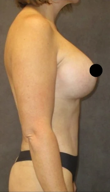 After: Tummy Tuck, Lipo to Abdomen, Breast Aug/Lift & BBL — profile · by Angelo Cuzalina, MD, DDS