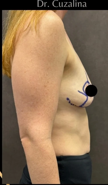 Before: Breast Augmentation & Mini Lift — profile · by Angelo Cuzalina, MD, DDS
