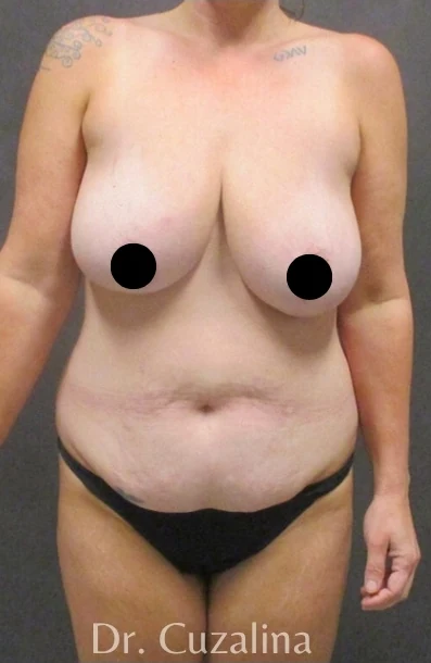 Before: Mommy Makeover — front · by Angelo Cuzalina, MD, DDS