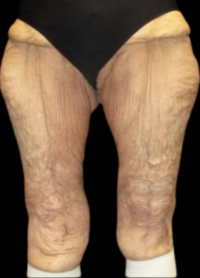 Before: Thigh & Knee Lift — front · by Angelo Cuzalina, MD, DDS