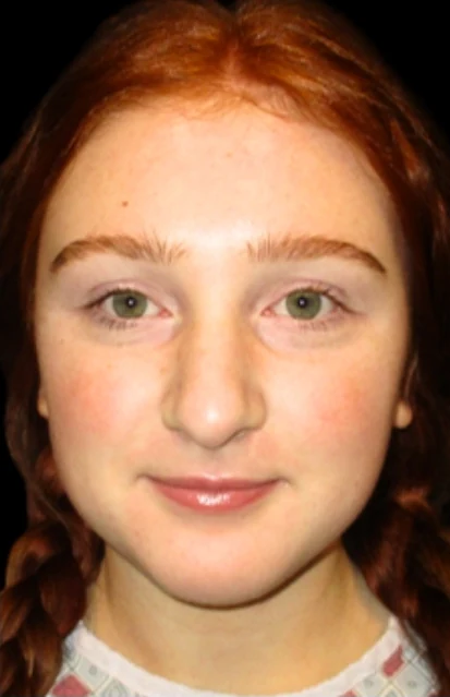 Before: Rhinoplasty — front · by Angelo Cuzalina, MD, DDS
