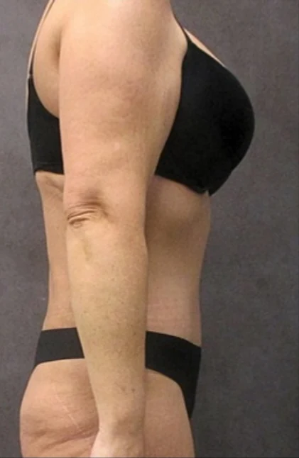 After: Tummy Tuck & Lipo 360 to Waist and Hips — profile · by Angelo Cuzalina, MD, DDS