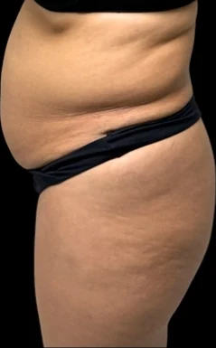 Before: Full Tummy Tuck, Hidef Lipo & BBL — oblique-back · by Pasquale Tolomeo, MD
