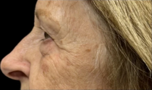 Before: Upper/Lower Blephs & Laser Resurfacing — profile-closeup · by Angelo Cuzalina, MD, DDS