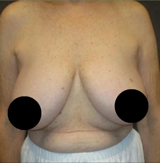 Before: Breast Reduction & Lift · by Angelo Cuzalina, MD, DDS