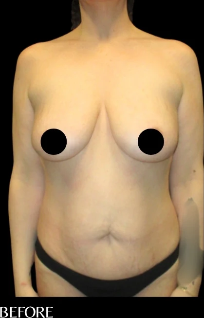 Before: Breast Aug/Lift · by Angelo Cuzalina, MD, DDS