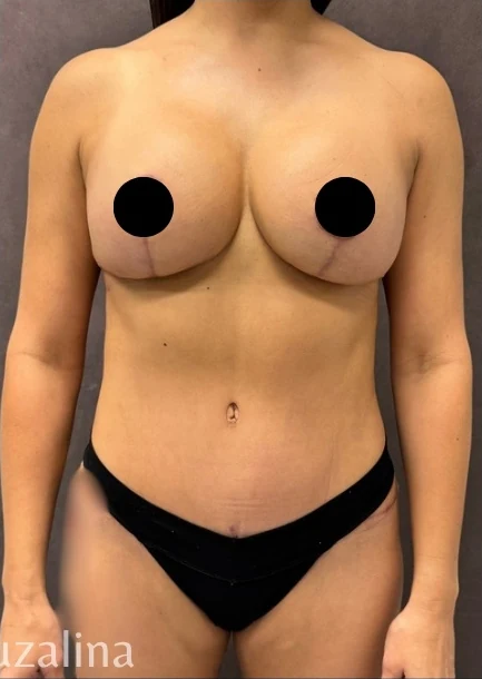 After: Full Mommy Makeover (Breast Aug/Lift | Lipo 360 | Lipo to Hips & Thighs | Tummy Tuck | ... — front · by Angelo Cuzalina, MD, DDS