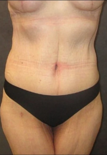 After: Tummy Tuck / Excessive Skin Removal — back · by Angelo Cuzalina, MD, DDS