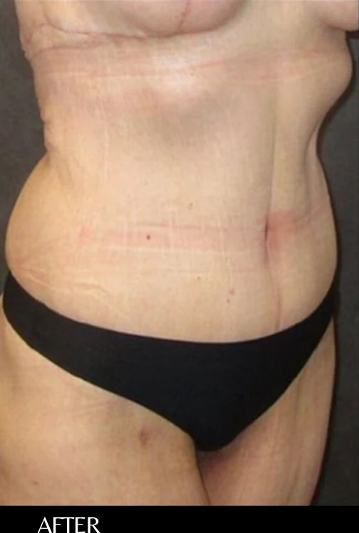 After: Tummy Tuck / Excessive Skin Removal — front · by Angelo Cuzalina, MD, DDS