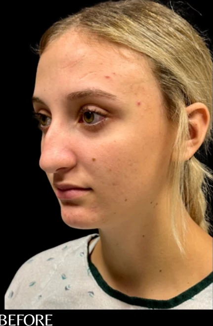 Before: Rhinoplasty — oblique · by Angelo Cuzalina, MD, DDS