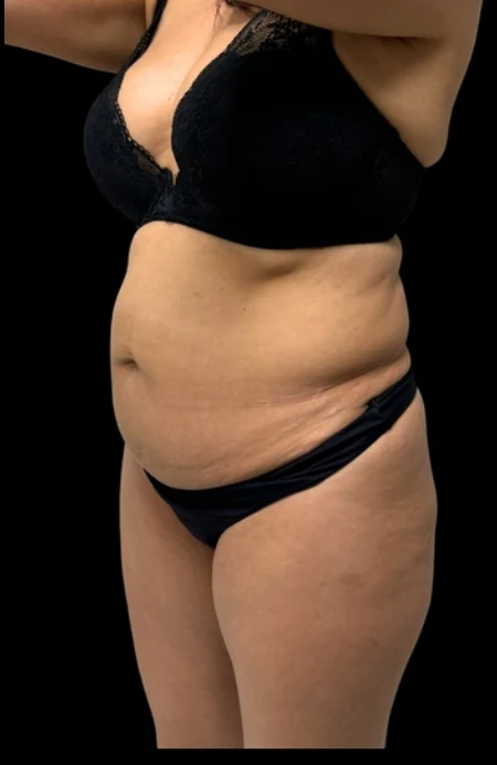 Before: Full Tummy Tuck, Hidef Lipo & BBL — oblique · by Pasquale Tolomeo, MD