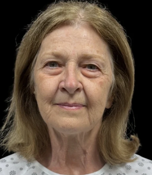 Before: Upper/Lower Blephs & Laser Resurfacing — front · by Angelo Cuzalina, MD, DDS