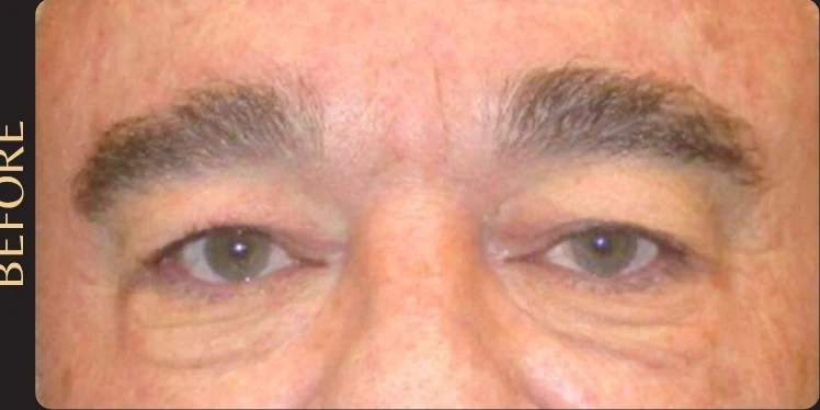 Before: Upper Eye Bleph w/ Fat Grafting Below the Eyes · by Angelo Cuzalina, MD, DDS