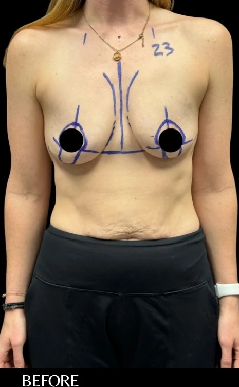 Before: Breast Augmentation · by Angelo Cuzalina, MD, DDS
