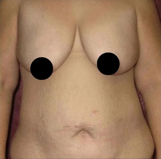 Before: Breast Reduction & Aug/Lift · by Angelo Cuzalina, MD, DDS
