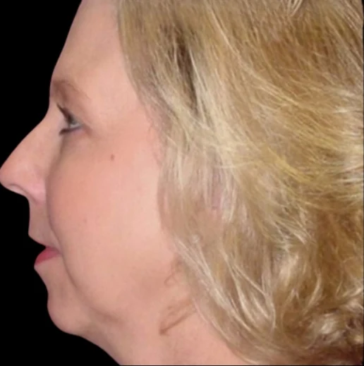 Before: Chin Augmentation, Deep Plane Lower Face Lift — profile · by Angelo Cuzalina, MD, DDS