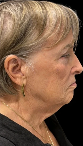 Before: Lower Face & Neck Lift, Chin Implant — profile · by Angelo Cuzalina, MD, DDS